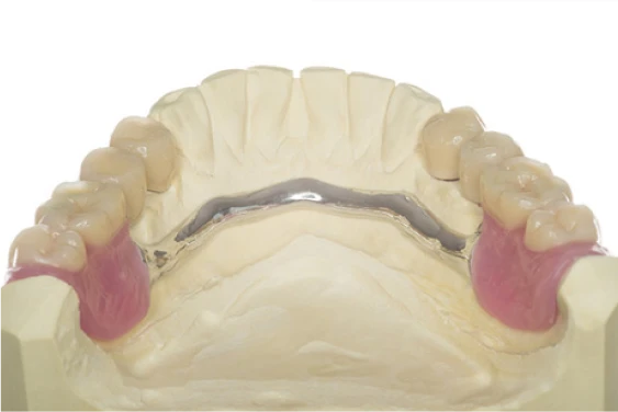 Digitális inlay, CAD/CAM provizórium 24 órán belül
