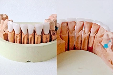 Préskerámia héjak